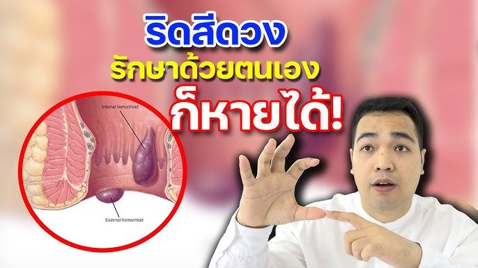 ริดสีดวงรูปจริง